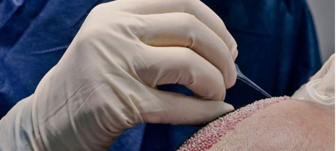 hair transplantation services in Istanbul